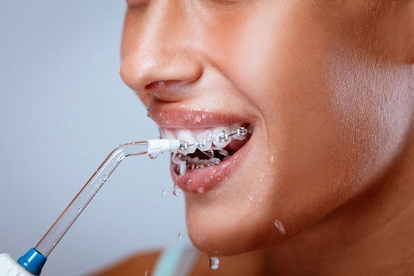 Vệ sinh sạch sẽ trong quá trình niềng răng là vấn đề cần thiết