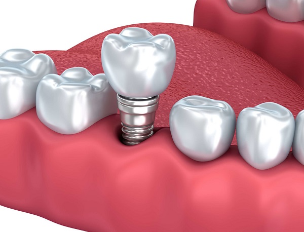 Phương pháp phục hình sứ trên Implant