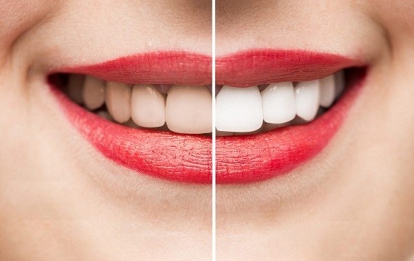 Với hàm răng trắng sáng sẽ giúp bạn tự tin hơn trong việc giao tiếp