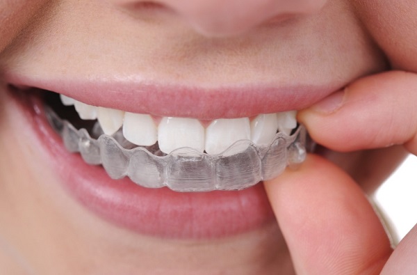 Phương pháp tẩy trắng răng tại nha khoa sẽ giúp mang lại độ bền màu cao hơn