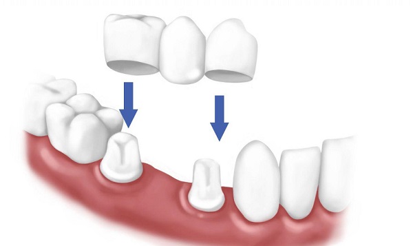 Liệu trồng răng sứ và cấp ghép implant thì phương pháp nào gây đau hơn?