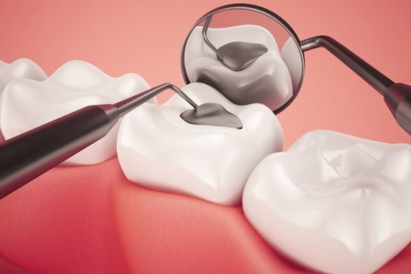 Trước khi trám răng thẩm mỹ cần chú ý gì