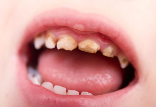 4 Bệnh về răng hay gặp phải nhất ở trẻ nhỏ