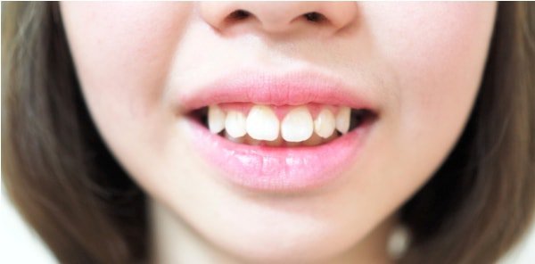 4 Bệnh về răng hay gặp phải nhất ở trẻ nhỏ