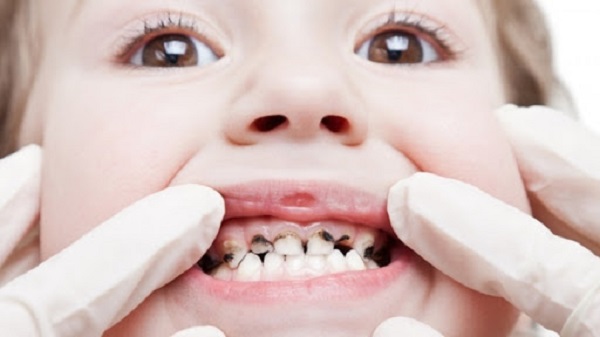 4 Bệnh về răng hay gặp phải nhất ở trẻ nhỏ