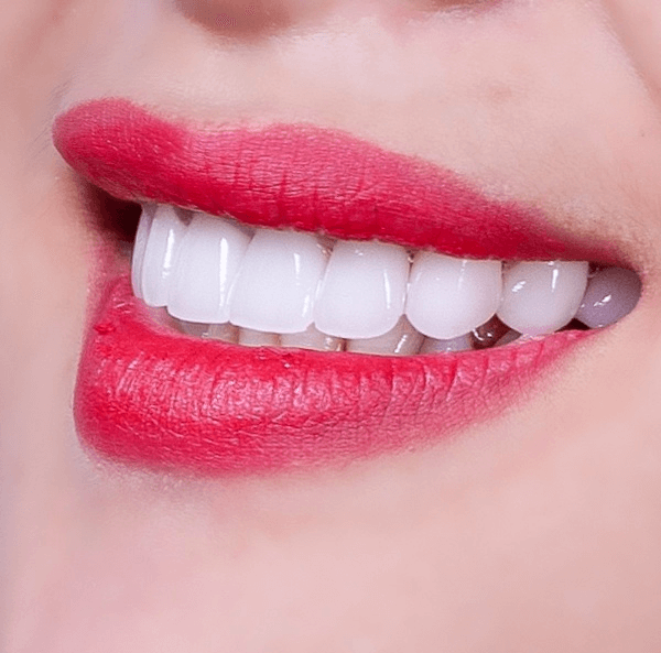 Răng sứ có độ tinh khiết, trằng ngà giúp nụ cười thêm tự tin, rạng rỡ