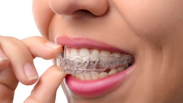 Trường hợp phải nhổ răng khi làm Invisalign sẽ đau âm ỉ trong một thời gian ngắn khi mới cài Invisalign