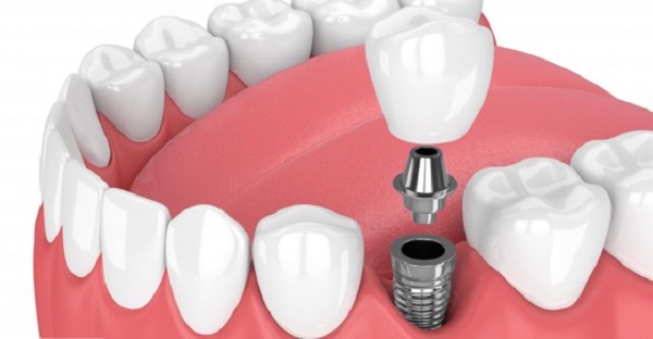 Bảng giá trồng răng hàm số 7 các loại