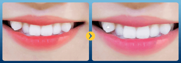 Có nên trồng răng khểnh hay không?