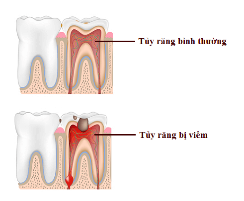 Viêm tuỷ răng sau khi bọc răng sứ