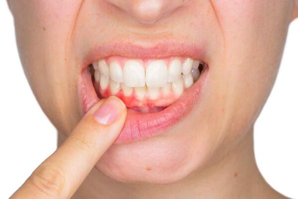 Lấy cao răng có làm hỏng men răng không?