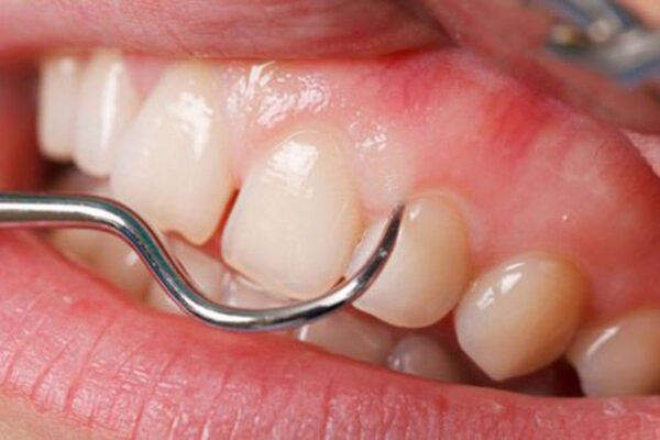 Thời gian lấy cao răng thế nào để không làm hỏng men răng