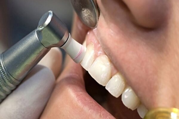 Quy trình lấy cao răng để không làm hỏng men răng