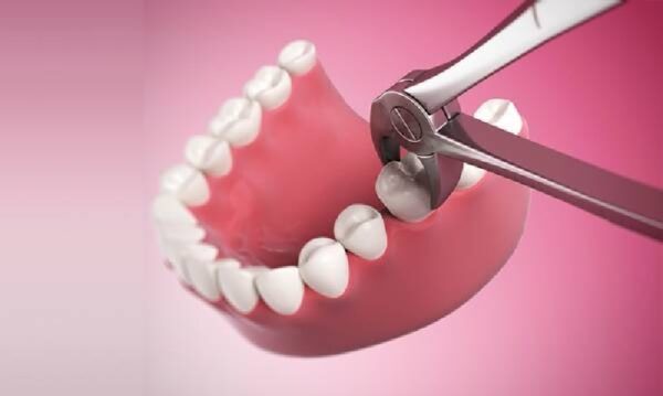 Nhổ răng số 7 cần phải thực hiện 1 cách cẩn thận nhất