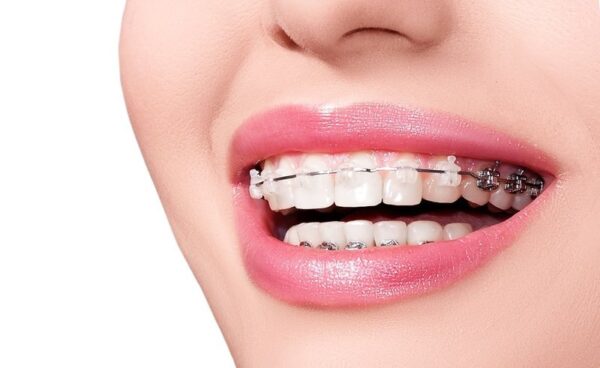 Niềng răng bằng mắc cài cố định