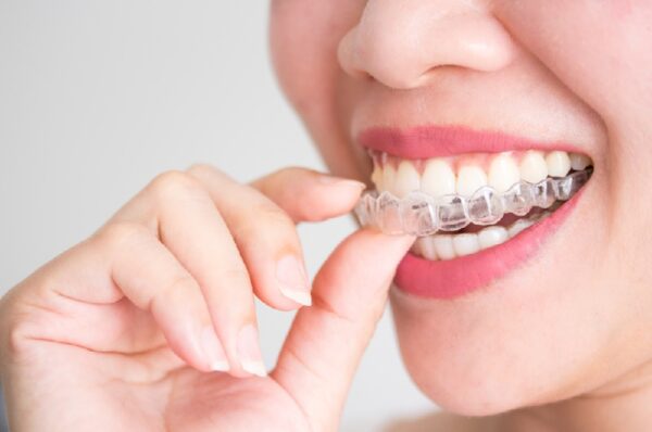 Phương pháp niềng răng trong suốt Invisalign