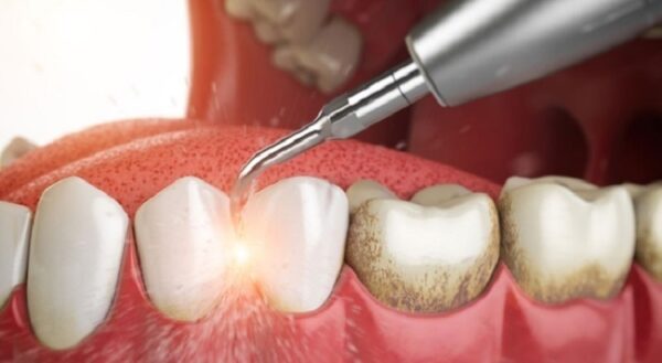 Những lưu ý khác cần tránh sau khi lấy cao răng