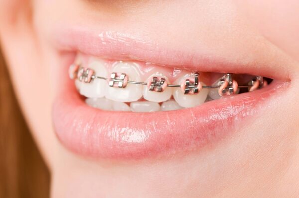 Niềng răng giúp bạn tự tin và có hàm răng chắc khỏe hơn