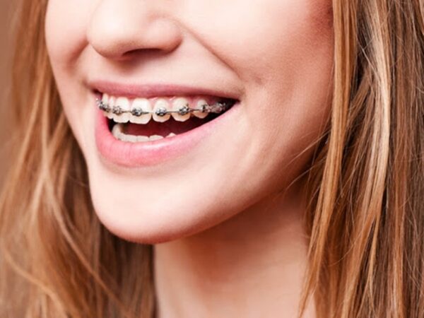 Trước khi niềng răng, bác sĩ cần có những kiểm tra – đánh giá cụ thể