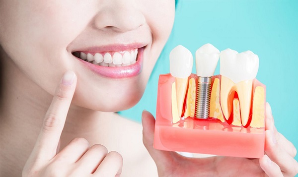 Sau khi trồng răng Implant bao lâu thì mới ăn được?
