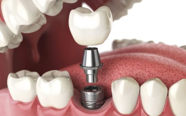Răng implant sau khi trồng cần một khoảng thời gian để hồi phục hoàn toàn hoàn toàn.  
